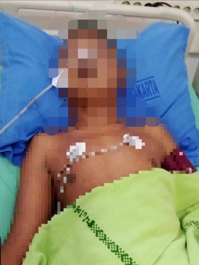 Bocah disabilitas di purwakarta